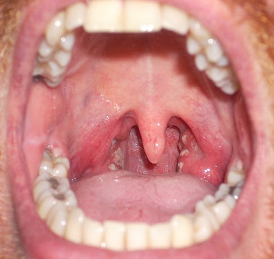 Constant Phlegm In Throat Since April 35