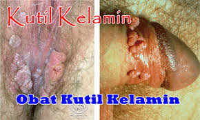 Kutil Kelamin Kutil Kelamin