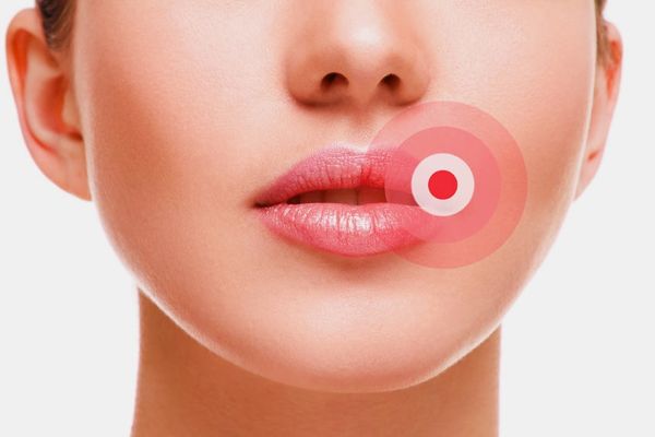 Bibir Kering dan Pecah-pecah cara mengatasi bibir yang kering