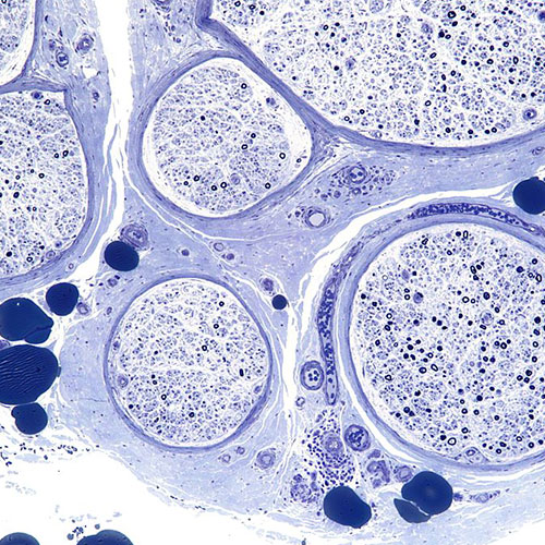 Acupuncture and How it can Assist in Chemotherapyinduced Peripheral