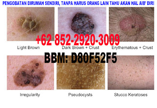 obat kutil
