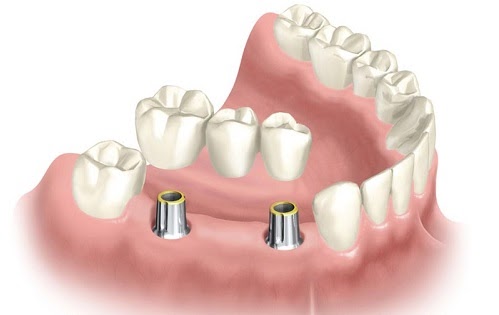 MẤT 3 RĂNG CẦN CẤY BAO NHIÊU TRỤ IMPLANT MẤT 3 RĂNG CẦN CẤY BAO NHIÊU TRỤ IMPLANT