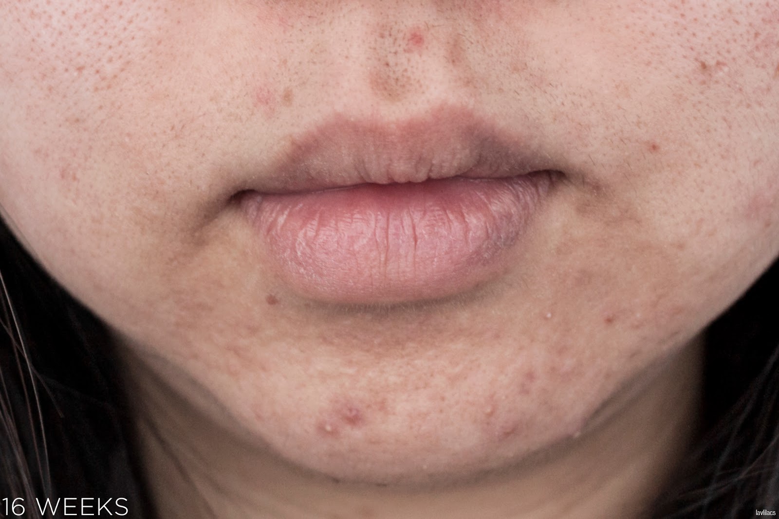 tria Hair Removal Laser Facial Hair 16 Weeks Closeup