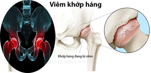 Các chi em cẩn thận với bệnh viêm khớp háng Các chi em cẩn thận với bệnh viêm khớp háng