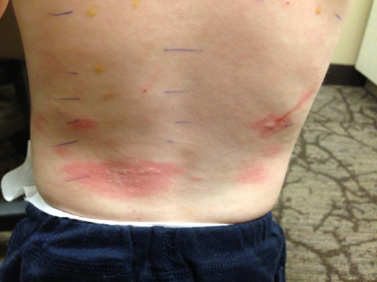 Advice & Adventures Food Allergy Insights