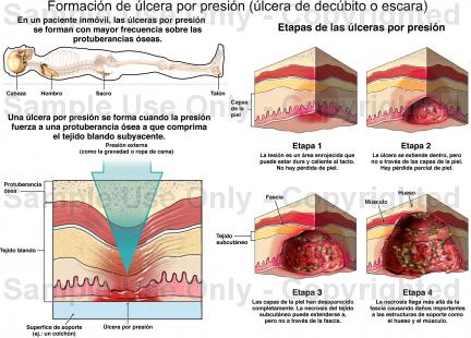 Infomecum Heridas - Guía del manejo de heridas y úlceras por presión y  vasculares