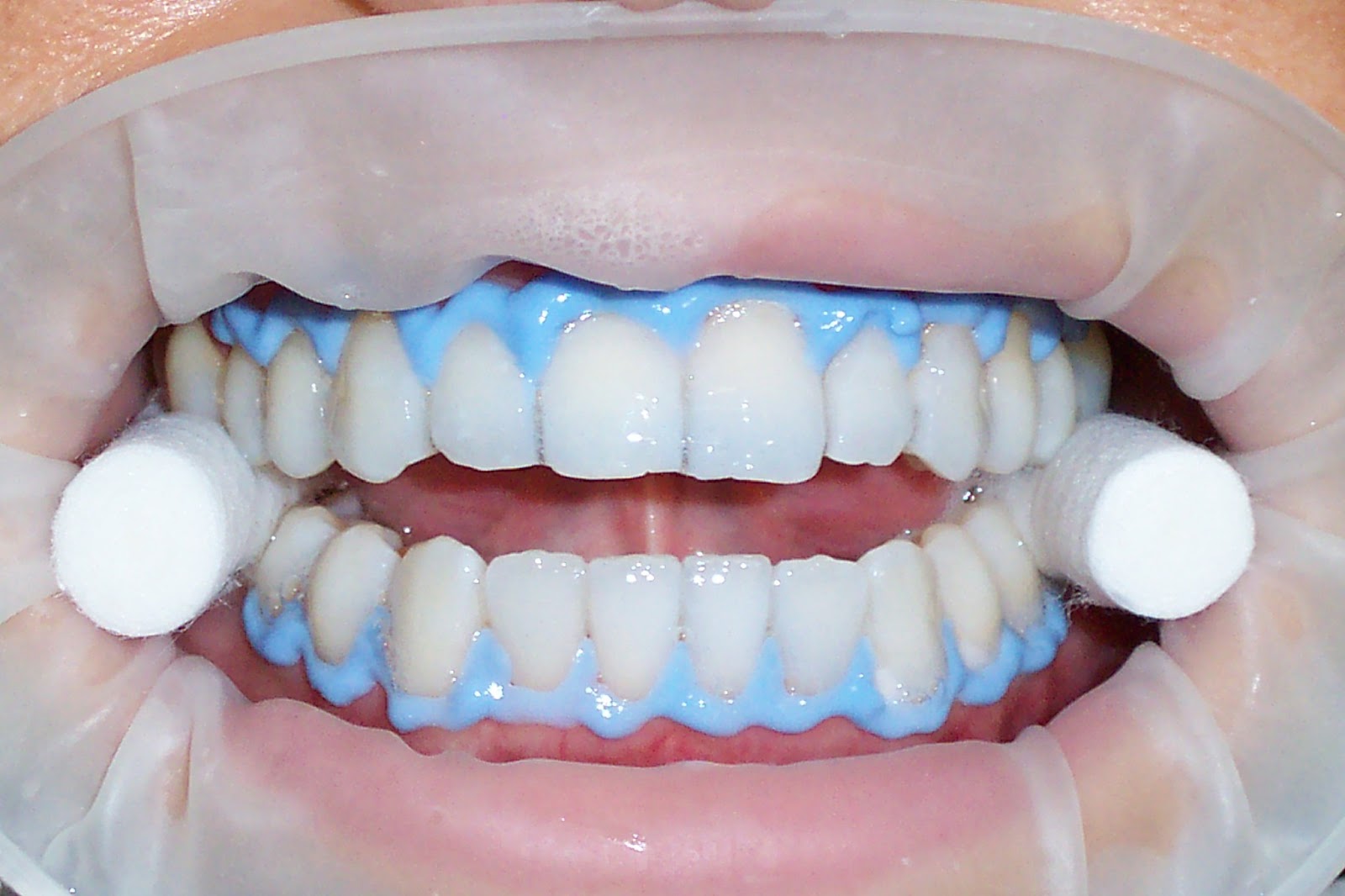 Зуб отбеливание пить. Красивые белые зубы. Химическое отбеливание зубов. Химическое отбеливание зубов в стоматологии. Мода на Естественные зубы.