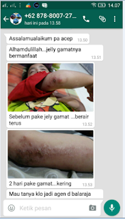 Cara Mengobati Impetigo pada Anak-anak, Bayi dan Dewasa Secara Alami