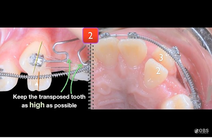 CLINICAL CASE: Treatment for Transposed Cuspid - Dr. Chris Chang