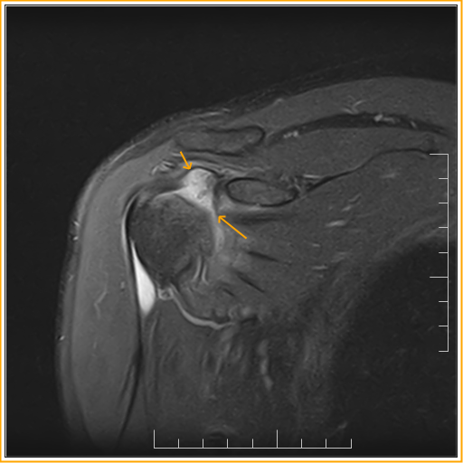 Adhesive Capsulitis MRI Sumer's Radiology Blog