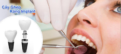 Cấy ghép răng với Implant có tác dụng gì?