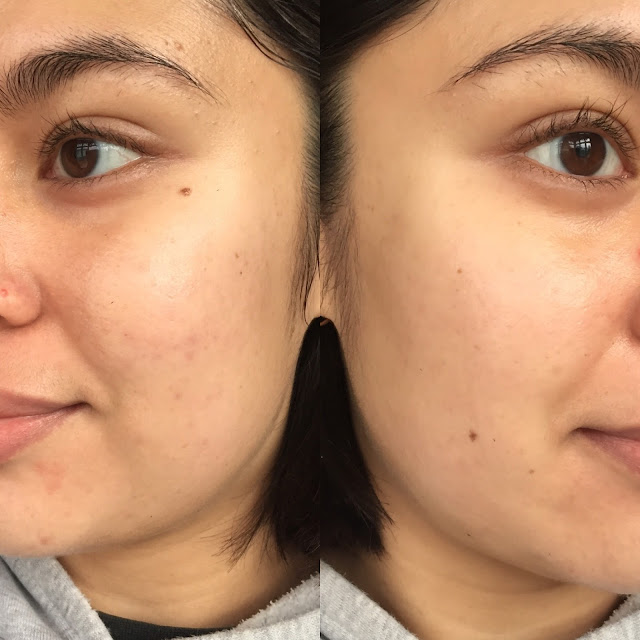 Retin A Before and After Photo - After, Good Tretinoin Acne Results