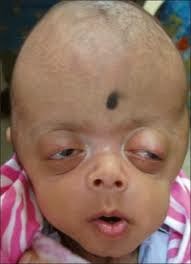 Medical Treatment Pictures For Better Understanding Crouzon Syndrome