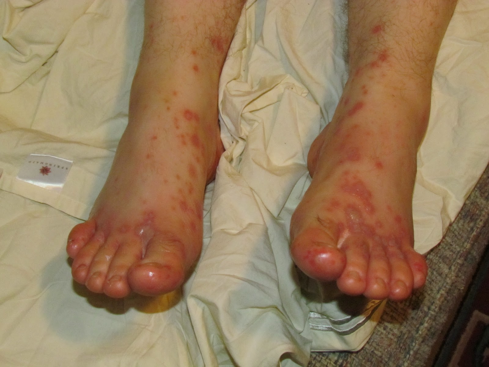 Travels with Aimer Hand, Foot and Ouch