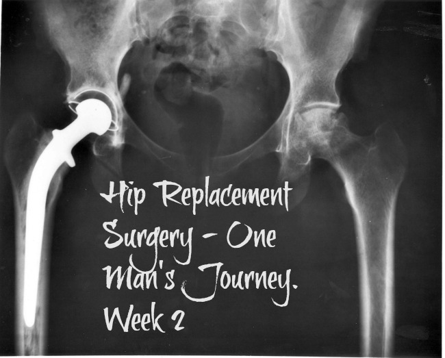 Hip-replacement-surgery-one-mans-journey-week-2-text-over-xray-of-a-hip-protheses-artificial-hip-joint