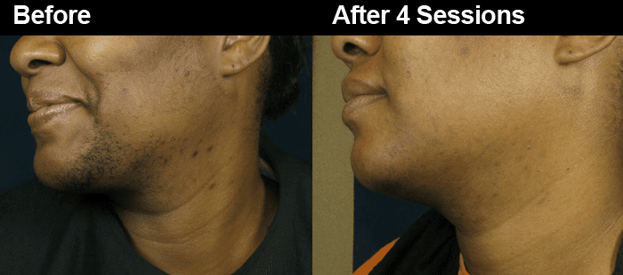 tattoo removal pierceing laser hair removal in accra ghana tattoo removal pierceing laser hair removal in accra ghana