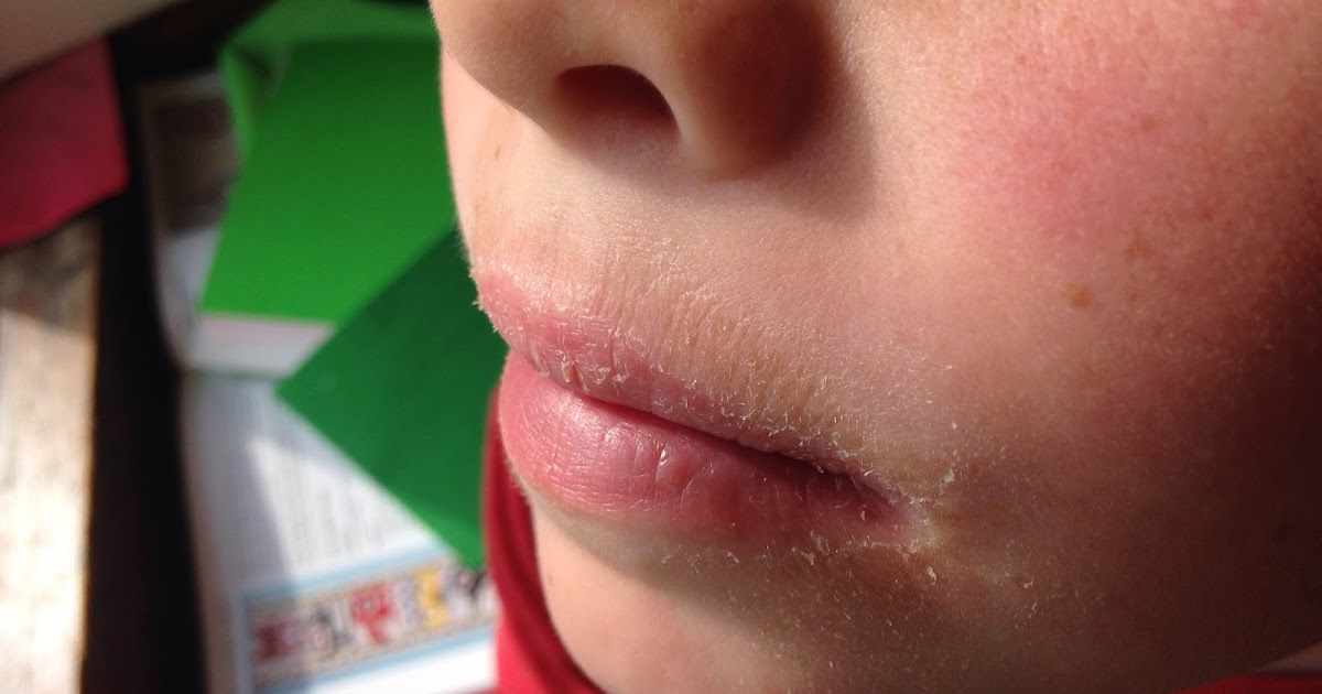 Lip Lick Dermatitis Childrens Faces dermatologist.co.uk
