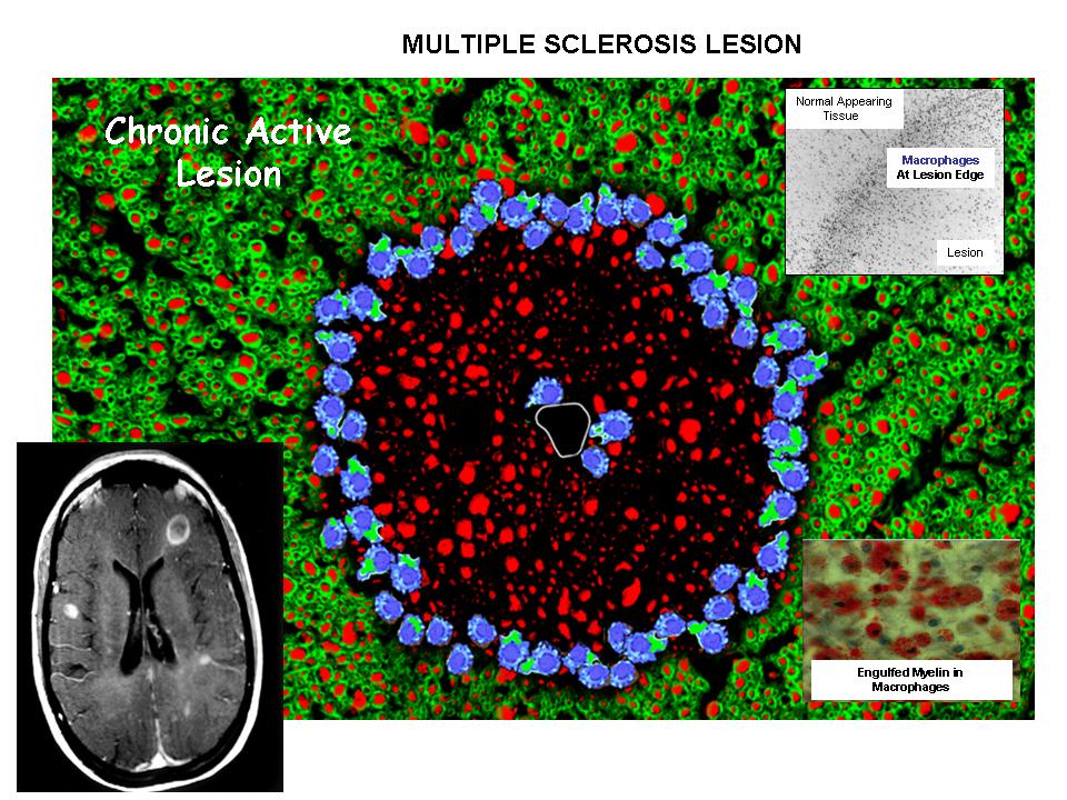 Multiple Sclerosis Research Education. Espresso Pathology. Lesion