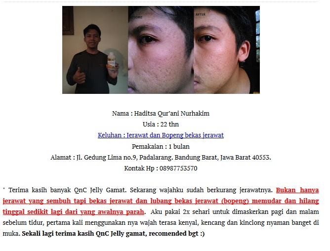 Bopeng Bisa Hilang Dengan Sendirinya