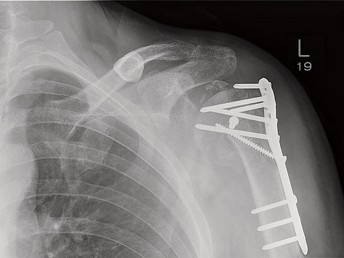 Рентгеновские пластины. Остеосинтез шейки плеча рентген. Остеосинтез шейки плечевой кости рентген. Перелом шейки плечевой кости рентген. Остеосинтез при переломе хирургической шейки плечевой кости.