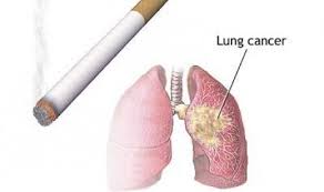 pengobatan tradisional kanker paru paru
