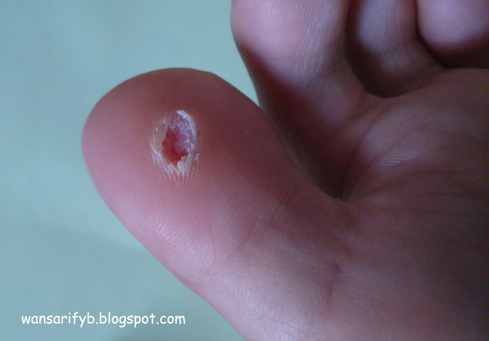 Cara Menghilangkan Mata Ikan