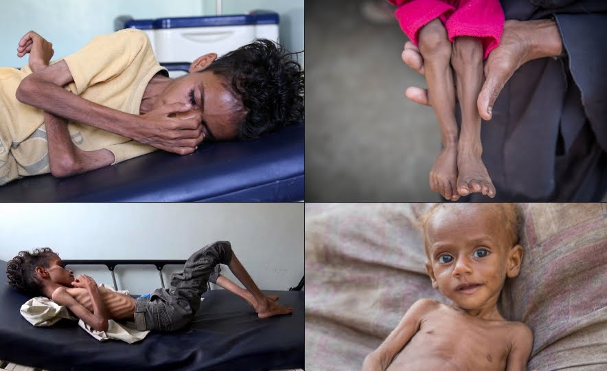 La tragedia inascoltata dei bambini in Yemen.