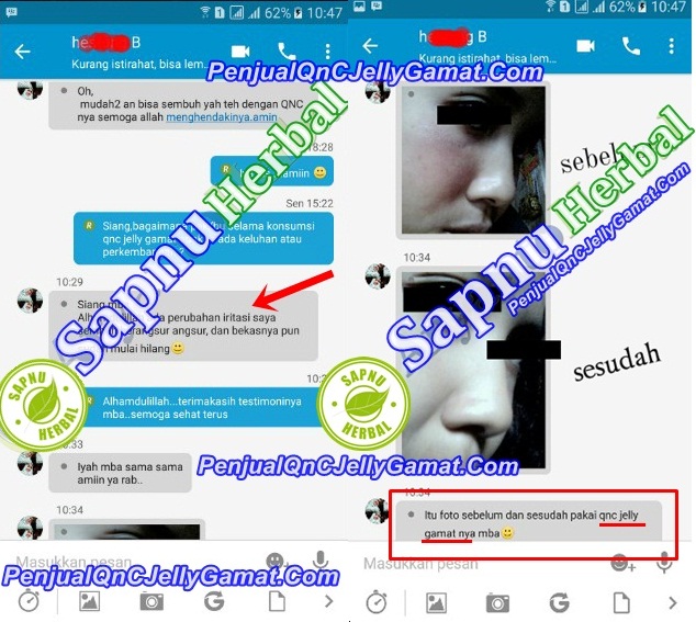 Cara Mengobati Kurap Di Selangkangan Secara Alami Sampai Tuntas Cara Mengobati Kurap Di Selangkangan Secara Alami Sampai Tuntas