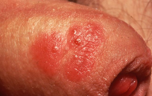 Painful sores on penis — img 8
