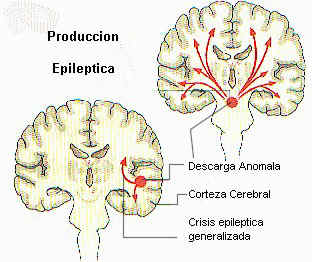 Resultado de imagen para epilepsia