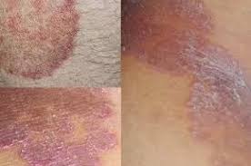 Obat Gatal Kulit Obat Gatal Kulit