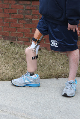 Leaving It All On The Field: Rotationplasty Prosthetic Leg...The Final ...