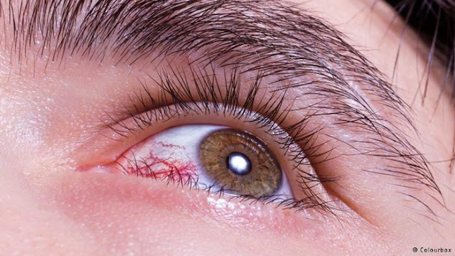   ما هي أسباب احمرار العين وكيف يؤثر أسلوب حياتنا على صحة العين؟ 0%252C%252C18522559_303%252C00