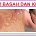 Cara mengatasi penyakit eksim basah gunakan obat herbal thumbnail