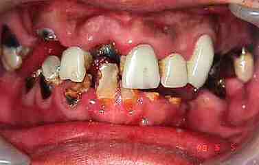 CARIES DENTAL Foto de caries dental