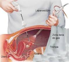 dolor pélvico después del ciclo en