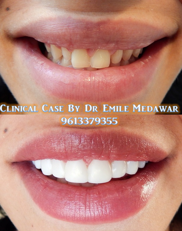 Implant Scars?  See Stunning Before & Afters That Will Inspire You - vncgvug