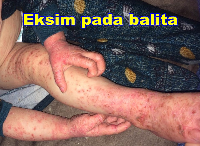 dermatitis atopic eksim eczema