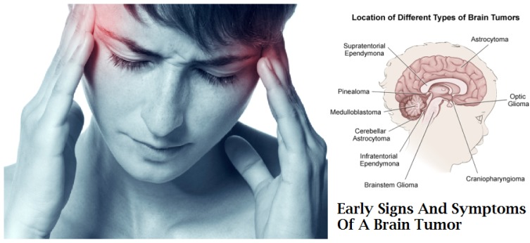 Early Symptoms of Brain Cancer - CancerOz