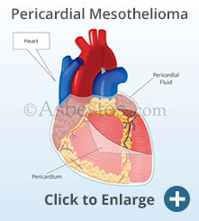 pericardial mesothelioma pericardial mesothelioma