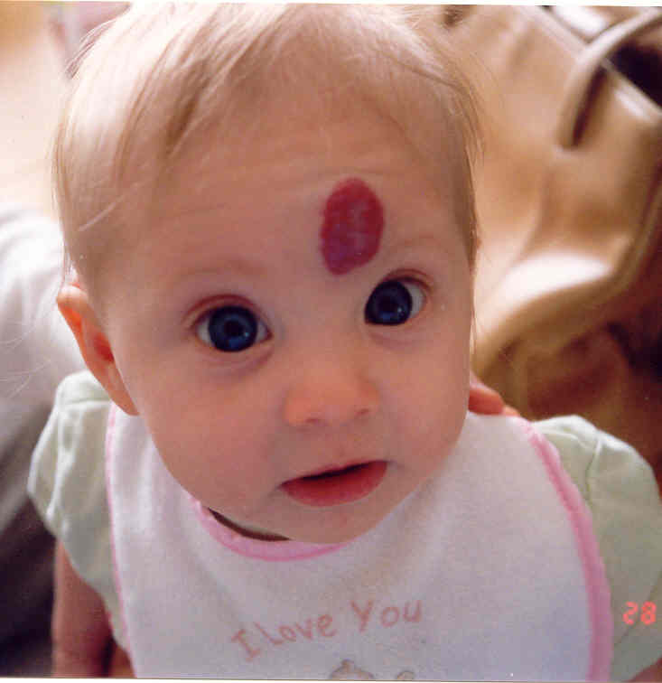 nevus rubi en bebes