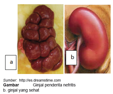 Gangguan Pada Sistem Ekskresi Manusia Maolioka