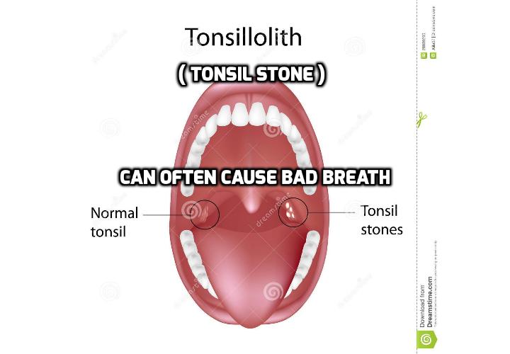 How To Have a Healthy Life Tonsil Stones (Tonsilloliths) can often