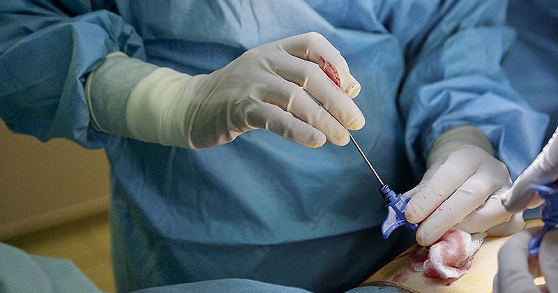biopsy