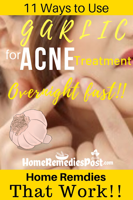 11 Ways To Use Garlic For Acne Removal Overnight Fast Garlic For Acne, Garlic Acne, Is Garlic Good For Acne, How To Use Garlic For Acne, Garlic And Acne, How To Get Rid Of Acne, How To Get Rid Of Acne Fast, Home Remedies For Acne, Acne Treatment,