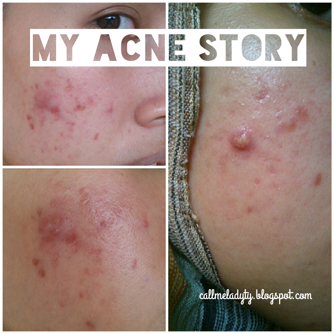 Tuty Saca My Acne Story