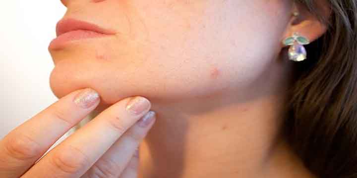 Mengatasi Jerawat Perawatan Kecantikan Kulit