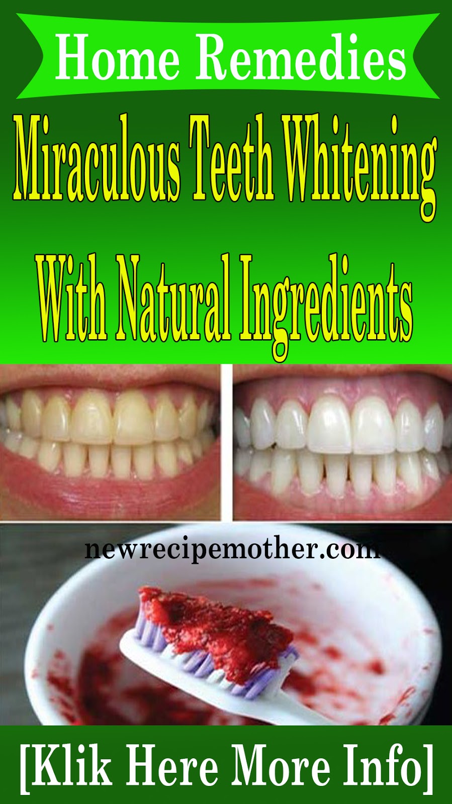 Miraculous Teeth Whitening Home Remedies With Natural Ingredients