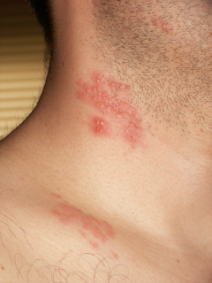 cara mengobati herpes zoster cara mengobati herpes zoster