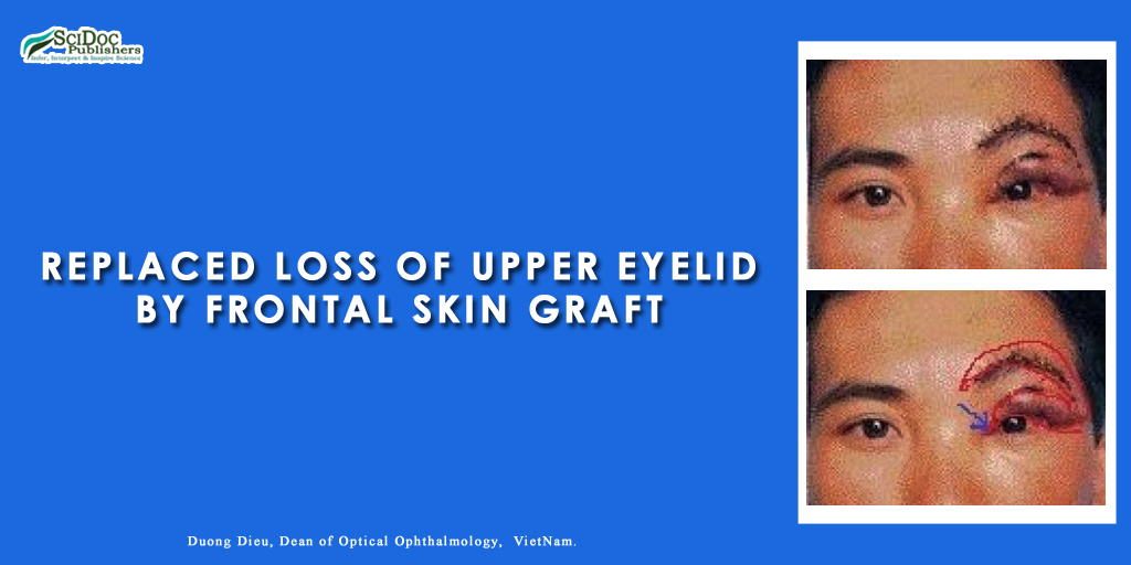 Replaced Loss of Upper Eyelid by Frontal Skin Graft